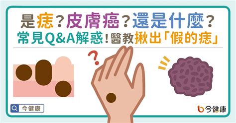 長毛痣|是痣or皮膚癌？醫「1張圖秒對照」 長這2部位最危險